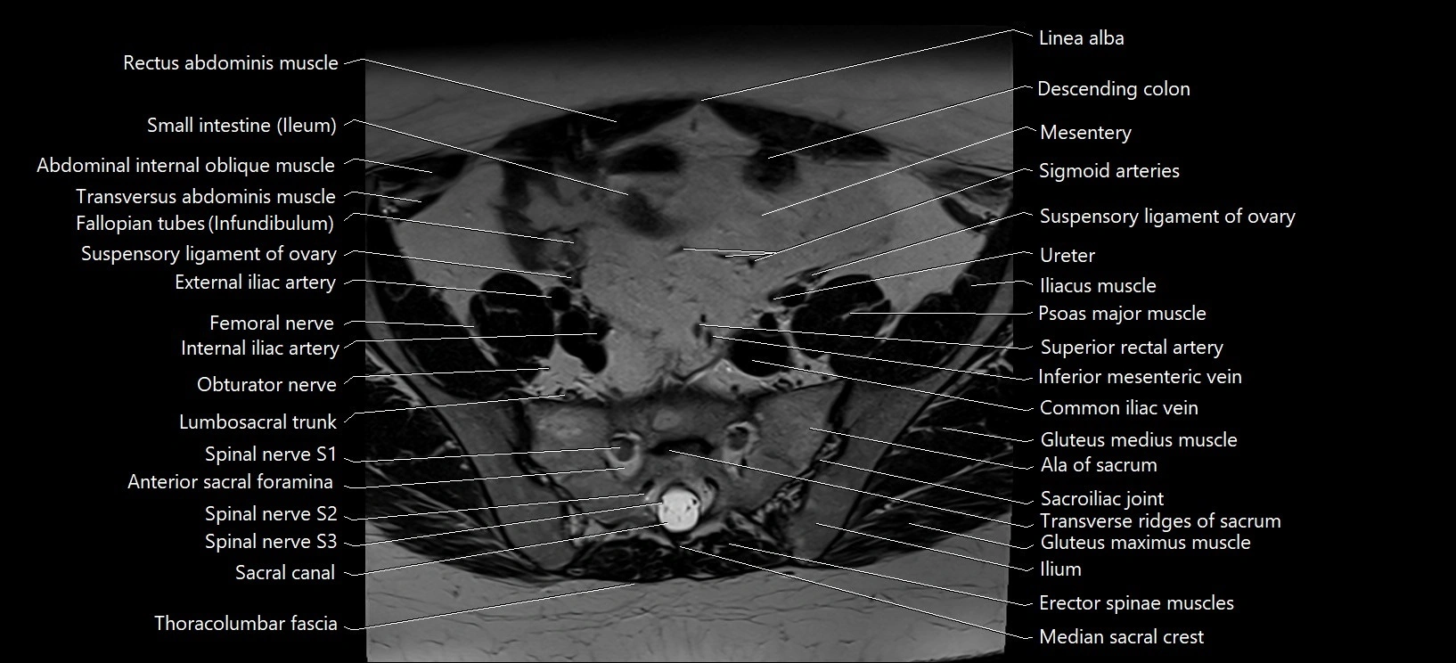 Axial cross sectional anatomy of female pelvis (MRI 3T) image 1.webp